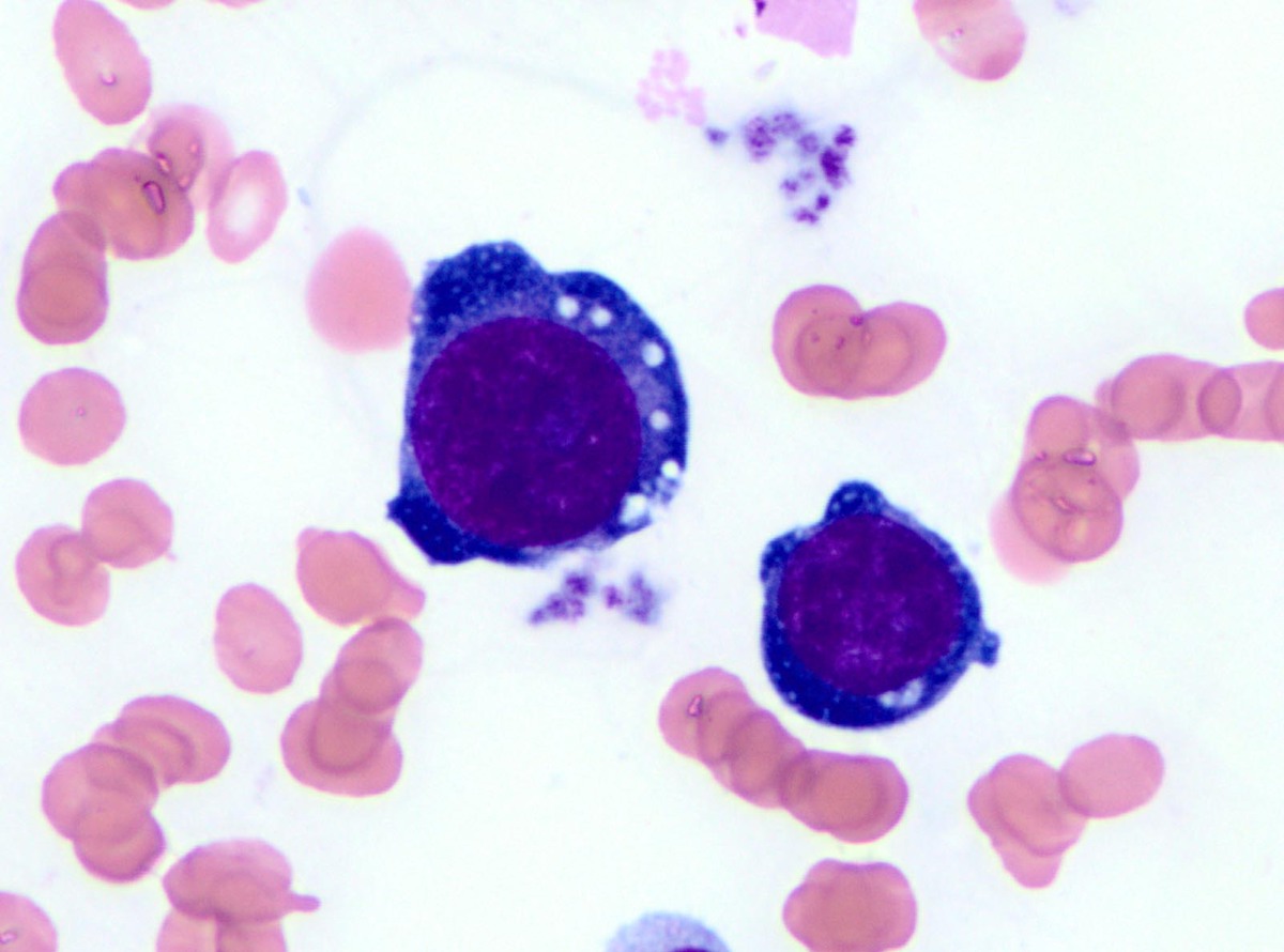 Erythroid precursors demonstrate cytoplasmic blebs and prominent vacuoles (Wright-Giemsa, 1000x)